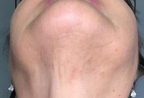 laser-hair-removal-chest-before-and-after-Impact-Cosmetics-Oakville6b.jpg laser-hair-removal-chest-before-and-after-Impact-Cosmetics-Oakville6b.jpg